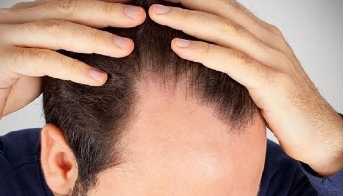 Hói chữ M là gì? Các kiểu tóc phù hợp hói chữ M cho đấng mày râu