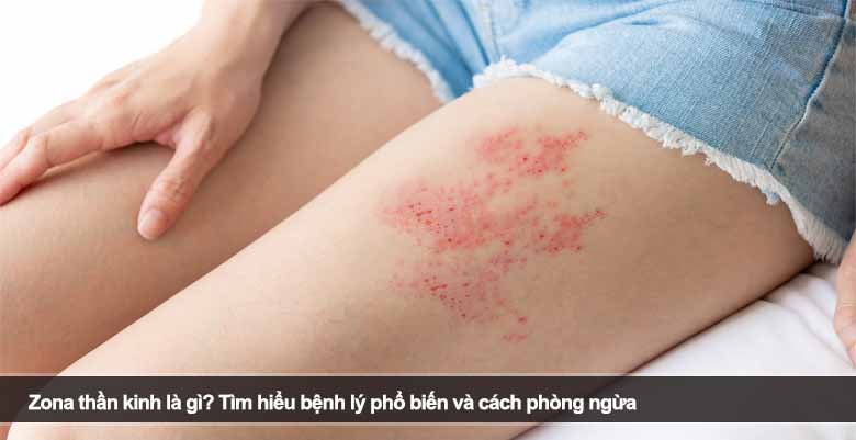 Zona thần kinh là gì? Tìm hiểu bệnh lý phổ biến và cách phòng ngừa