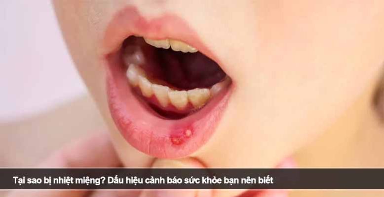 Tại sao bị nhiệt miệng? Dấu hiệu cảnh báo sức khỏe bạn nên biết