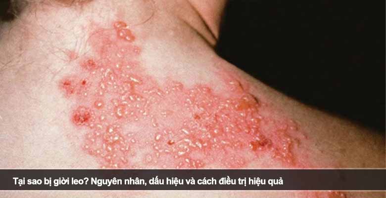 Tại sao bị giời leo? Nguyên nhân, dấu hiệu và cách điều trị hiệu quả
