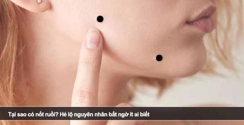 Tại sao có nốt ruồi? Hé lộ nguyên nhân bất ngờ ít ai biết