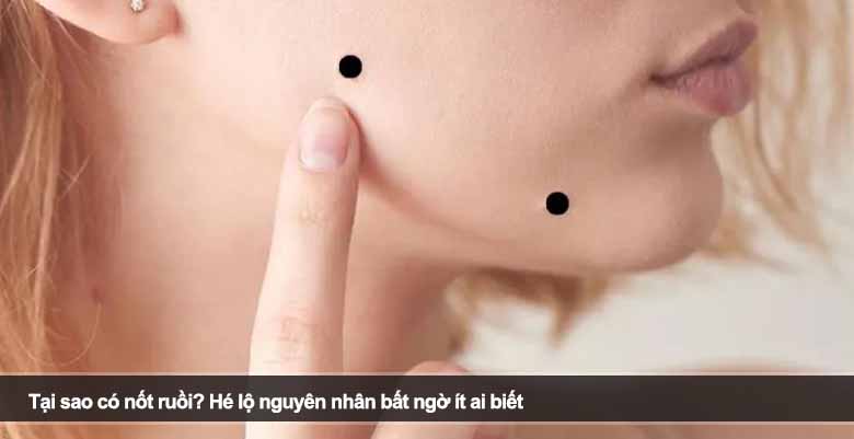 Tại sao có nốt ruồi? Hé lộ nguyên nhân bất ngờ ít ai biết 