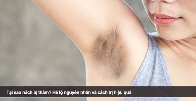 Tại sao nách bị thâm? Hé lộ nguyên nhân và cách trị hiệu quả 